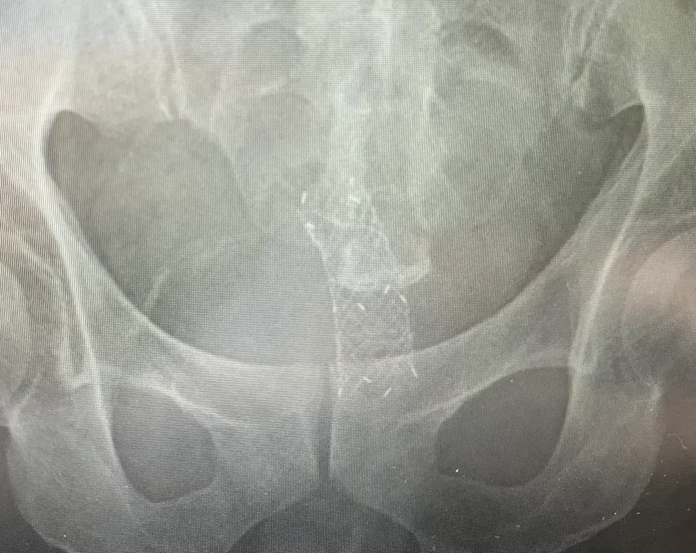 大腸に挿入したステントのレントゲン画像