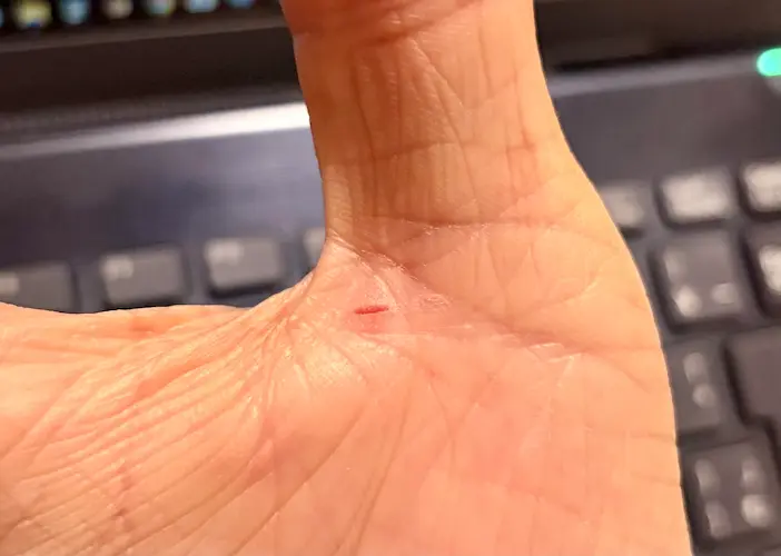 ひび割れた皮膚