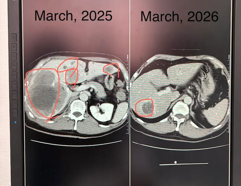 CT画像検査の結果、肝臓転移の大腸がん（腫瘍マーカー2223と4の比較）