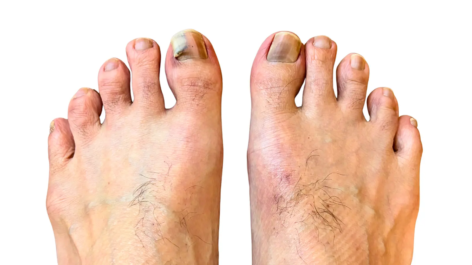 左足の親指の爪がめくれあがった画像