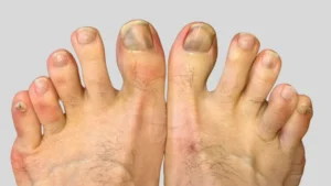 抗がん剤(ベクティビックス)、足の指