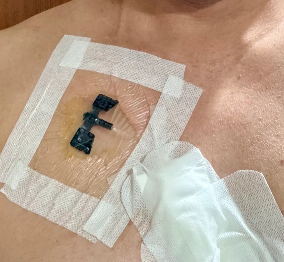 抗がん剤点滴中、CVポートに針を刺してフィルムとテープで固定した胸元